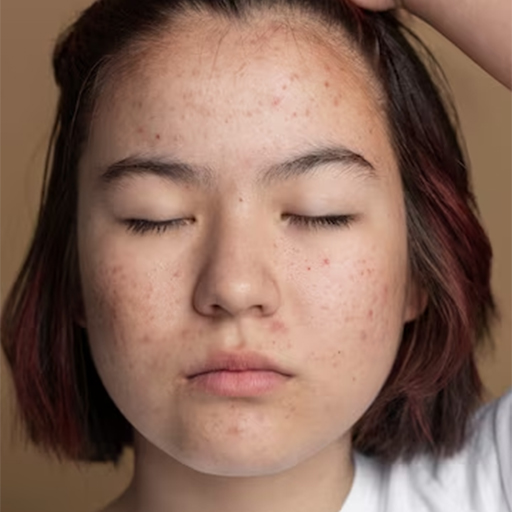 Acne prone dry skin