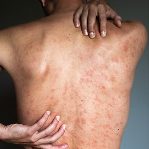 Eczematous skin